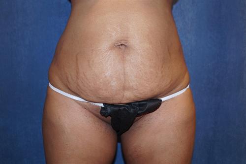 TUMMY TUCK CASE 351