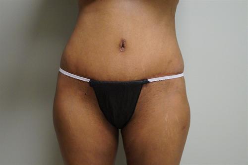 TUMMY TUCK CASE 351