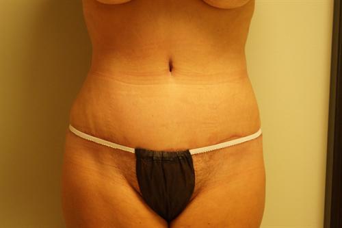 TUMMY TUCK CASE 352