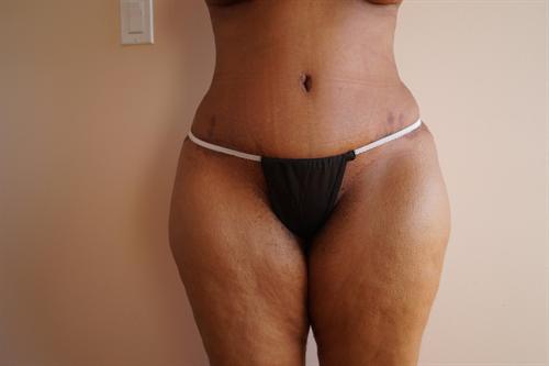 TUMMY TUCK CASE 353