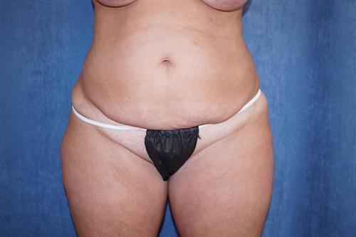 TUMMY TUCK CASE 354