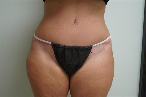 TUMMY TUCK CASE 354