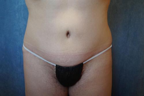 TUMMY TUCK CASE 355