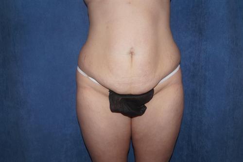 TUMMY TUCK CASE 357