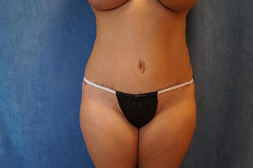 TUMMY TUCK CASE 357