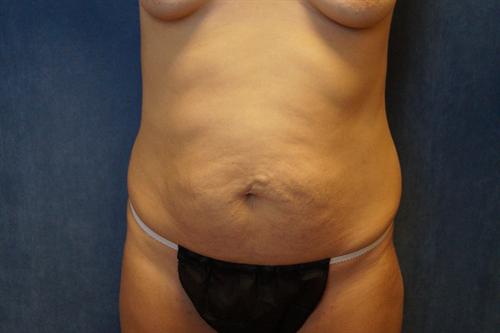 TUMMY TUCK CASE 358