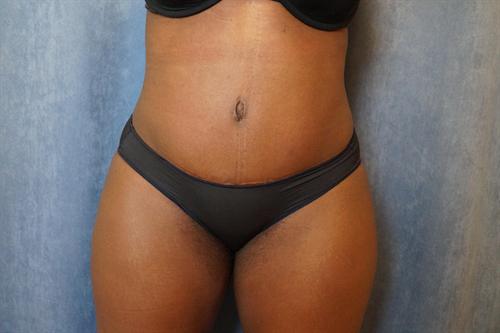 TUMMY TUCK CASE 359