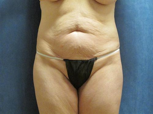 TUMMY TUCK CASE 360