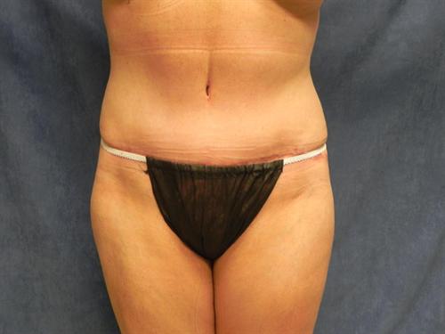 TUMMY TUCK CASE 360