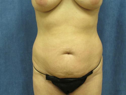 TUMMY TUCK CASE 361