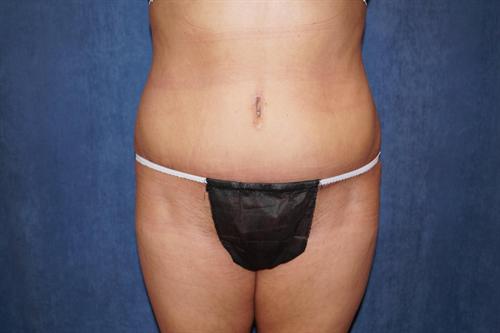 TUMMY TUCK CASE 361