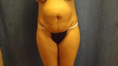 TUMMY TUCK CASE 362