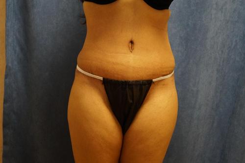 TUMMY TUCK CASE 362