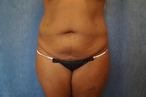 TUMMY TUCK CASE 363