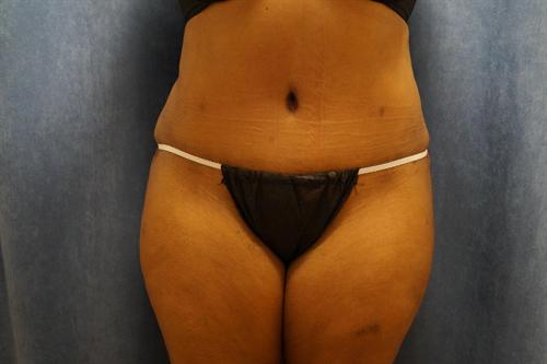 TUMMY TUCK CASE 363