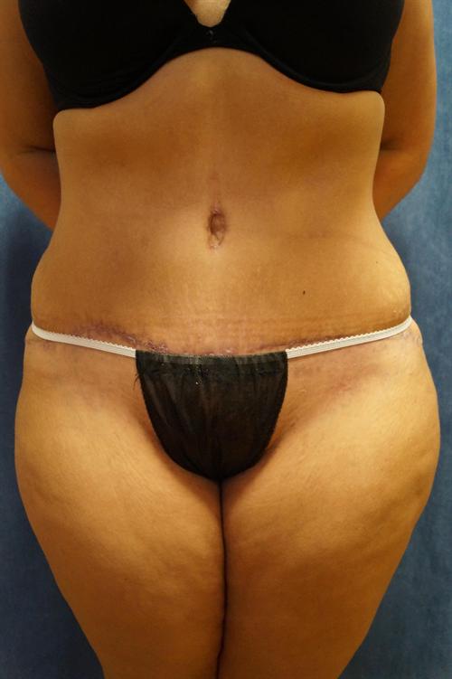 TUMMY TUCK CASE 364