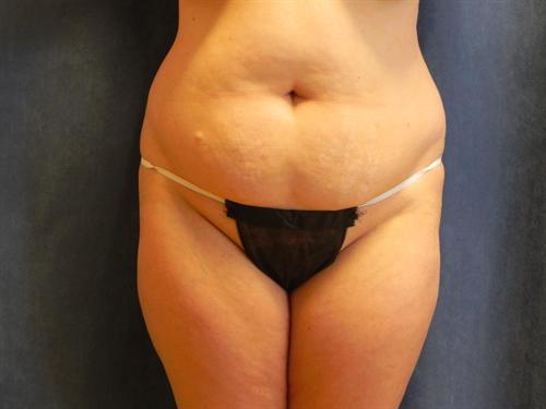 TUMMY TUCK CASE 365