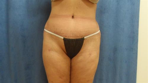 TUMMY TUCK CASE 365