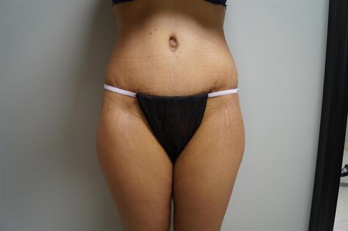 TUMMY TUCK CASE 367