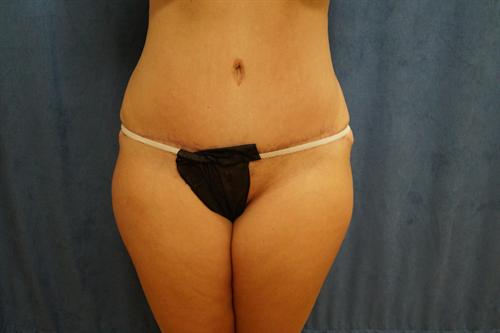 TUMMY TUCK CASE 368