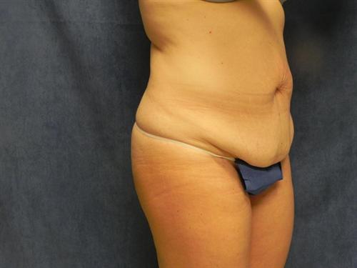 TUMMY TUCK CASE 369