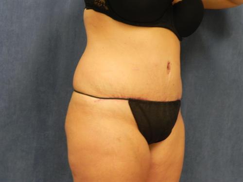 TUMMY TUCK CASE 369