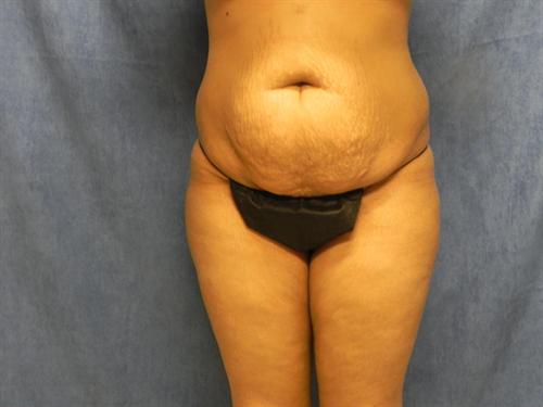 TUMMY TUCK CASE 370