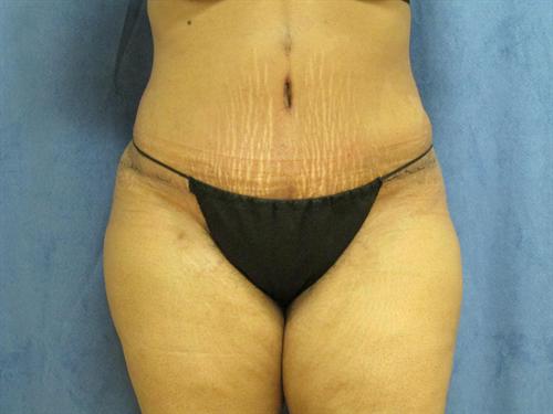 TUMMY TUCK CASE 370