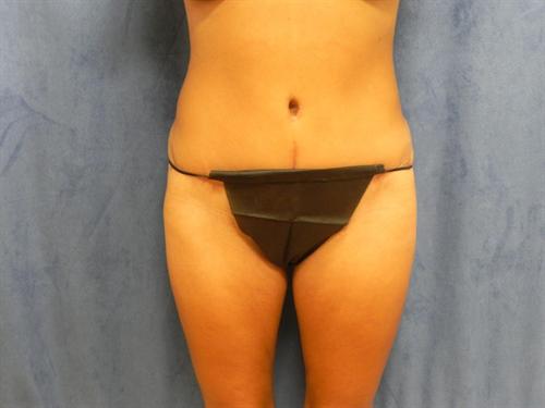 TUMMY TUCK CASE 372