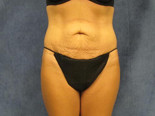 TUMMY TUCK CASE 374