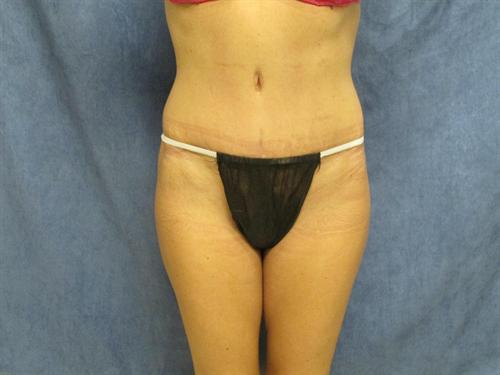 TUMMY TUCK CASE 374