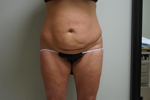 TUMMY TUCK CASE 375