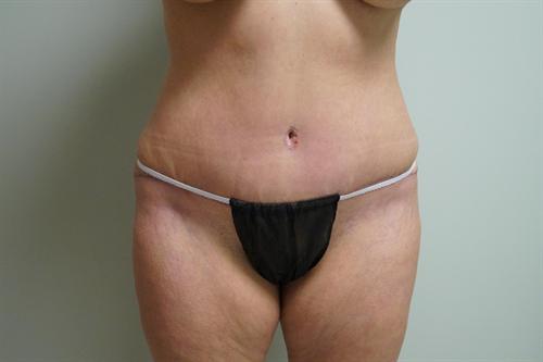 TUMMY TUCK CASE 375