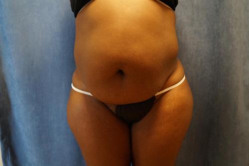 TUMMY TUCK CASE 376