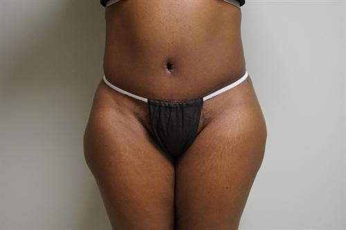 TUMMY TUCK CASE 376