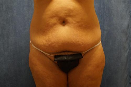 TUMMY TUCK CASE 377