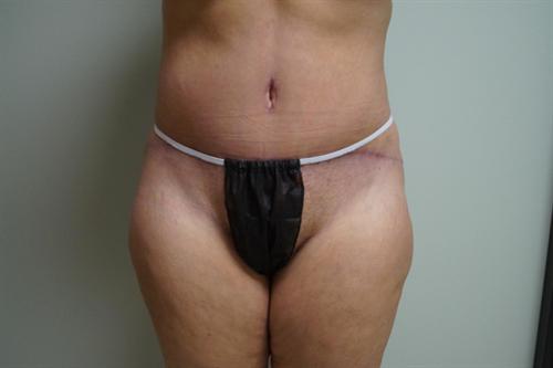 TUMMY TUCK CASE 377