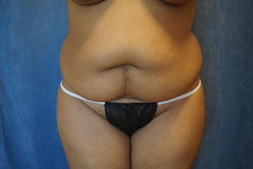 TUMMY TUCK CASE 378