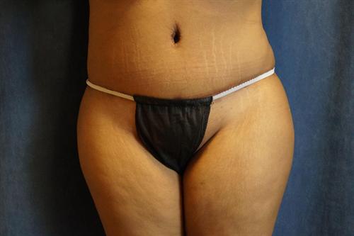 TUMMY TUCK CASE 378