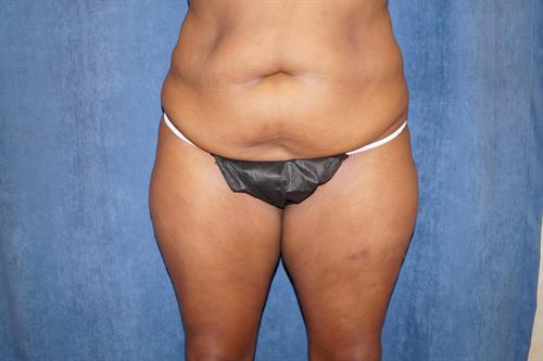 TUMMY TUCK CASE 379