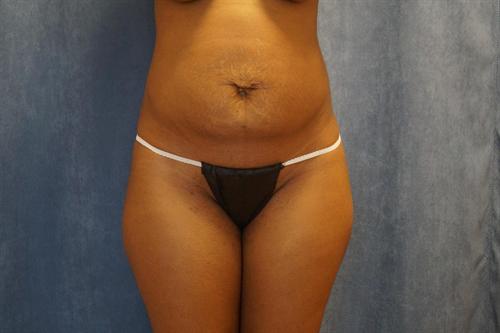 TUMMY TUCK CASE 380