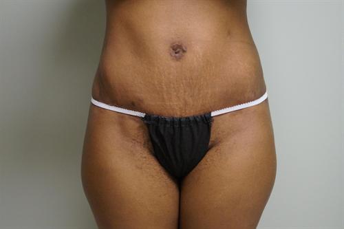 TUMMY TUCK CASE 380