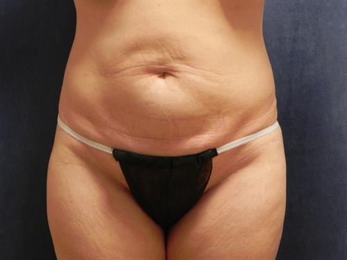 TUMMY TUCK CASE 381