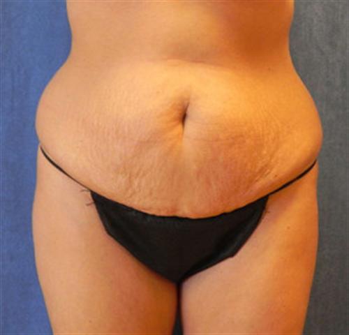 TUMMY TUCK CASE 382