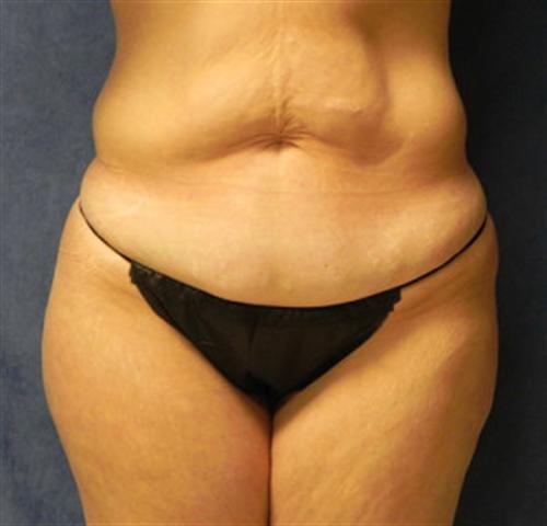 TUMMY TUCK CASE 383