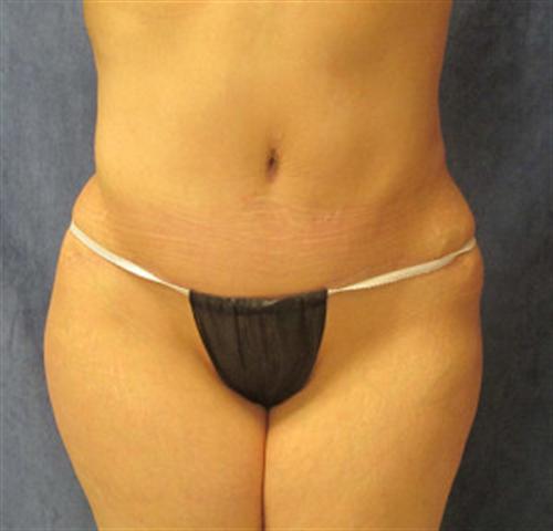 TUMMY TUCK CASE 383