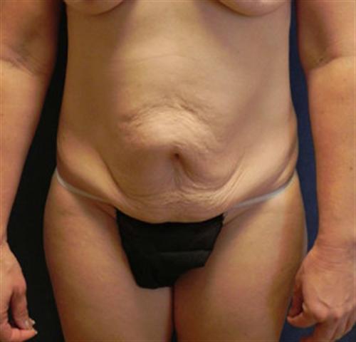 TUMMY TUCK CASE 384