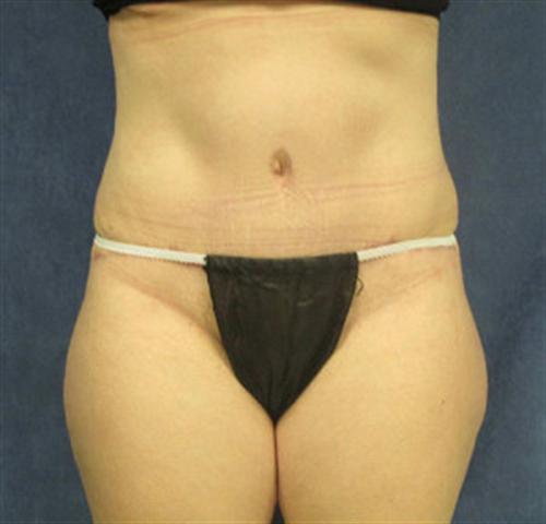 TUMMY TUCK CASE 384