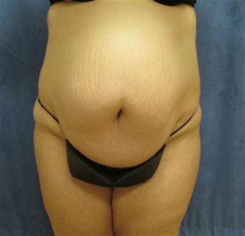 TUMMY TUCK CASE 385