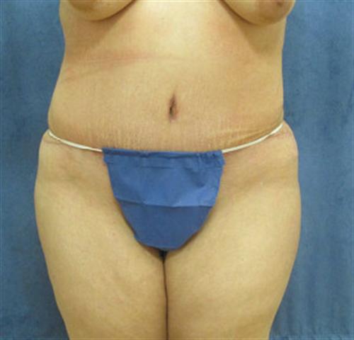 TUMMY TUCK CASE 385